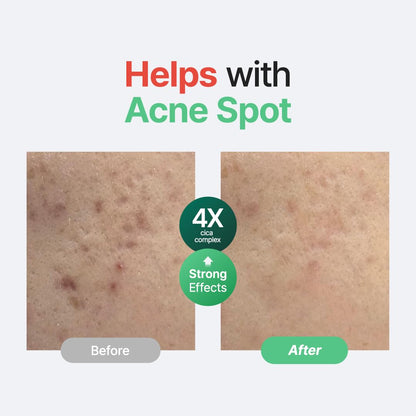 Centella Unscented Serum, 34,860 Ppm Centella, Facial Serum for Sensitive Skin & Acne-Prone Skin, Soothing Serum, Vegan & Cruelty-Free, Korean Skincare, 2 Fl.Oz / 60Ml